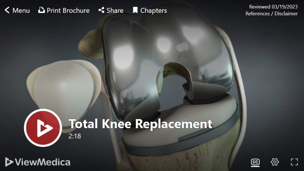 total knee replacement video